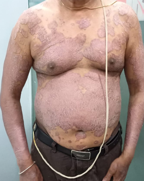 Psoriasis treatment before result